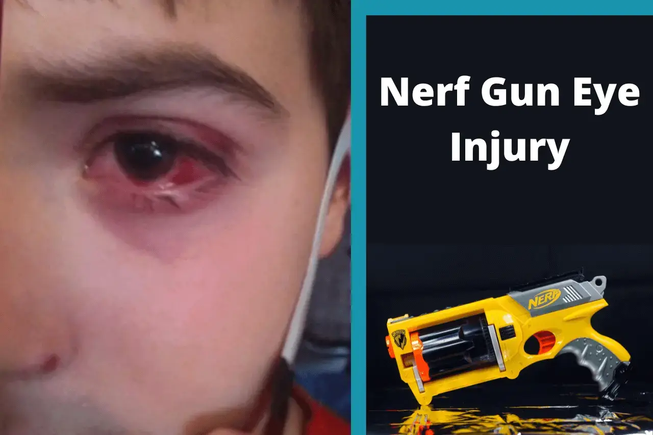 Nerf Gun Eye Injury